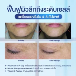 boneta โบเนต้า ครีมบำรุงผิว ลดฝ้า กระ จุดด่างดำ ริ้วรอย กระชับรูบขุมขน ทัตถการ ศัลยกรรม โบท็อก นวดหน้า