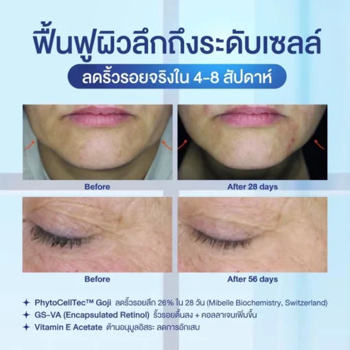boneta โบเนต้า ครีมบำรุงผิว ลดฝ้า กระ จุดด่างดำ ริ้วรอย กระชับรูบขุมขน ทัตถการ ศัลยกรรม โบท็อก นวดหน้า