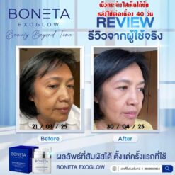 boneta โบเนต้า ครีมบำรุงผิว ลดฝ้า กระ จุดด่างดำ ริ้วรอย กระชับรูบขุมขน ทัตถการ ศัลยกรรม โบท็อก นวดหน้า