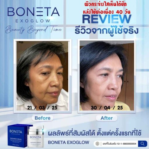 boneta โบเนต้า ครีมบำรุงผิว ลดฝ้า กระ จุดด่างดำ ริ้วรอย กระชับรูบขุมขน ทัตถการ ศัลยกรรม โบท็อก นวดหน้า