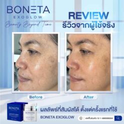 boneta โบเนต้า ครีมบำรุงผิว ลดฝ้า กระ จุดด่างดำ ริ้วรอย กระชับรูบขุมขน ทัตถการ ศัลยกรรม โบท็อก นวดหน้า