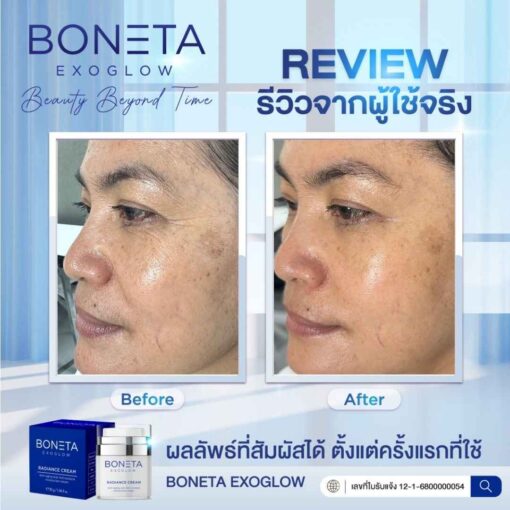 boneta โบเนต้า ครีมบำรุงผิว ลดฝ้า กระ จุดด่างดำ ริ้วรอย กระชับรูบขุมขน ทัตถการ ศัลยกรรม โบท็อก นวดหน้า