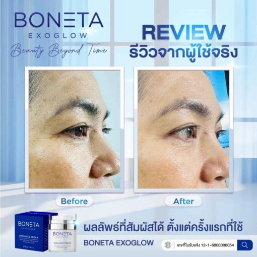 boneta โบเนต้า ครีมบำรุงผิว ลดฝ้า กระ จุดด่างดำ ริ้วรอย กระชับรูบขุมขน ทัตถการ ศัลยกรรม โบท็อก นวดหน้า