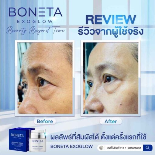 boneta โบเนต้า ครีมบำรุงผิว ลดฝ้า กระ จุดด่างดำ ริ้วรอย กระชับรูบขุมขน ทัตถการ ศัลยกรรม โบท็อก นวดหน้า